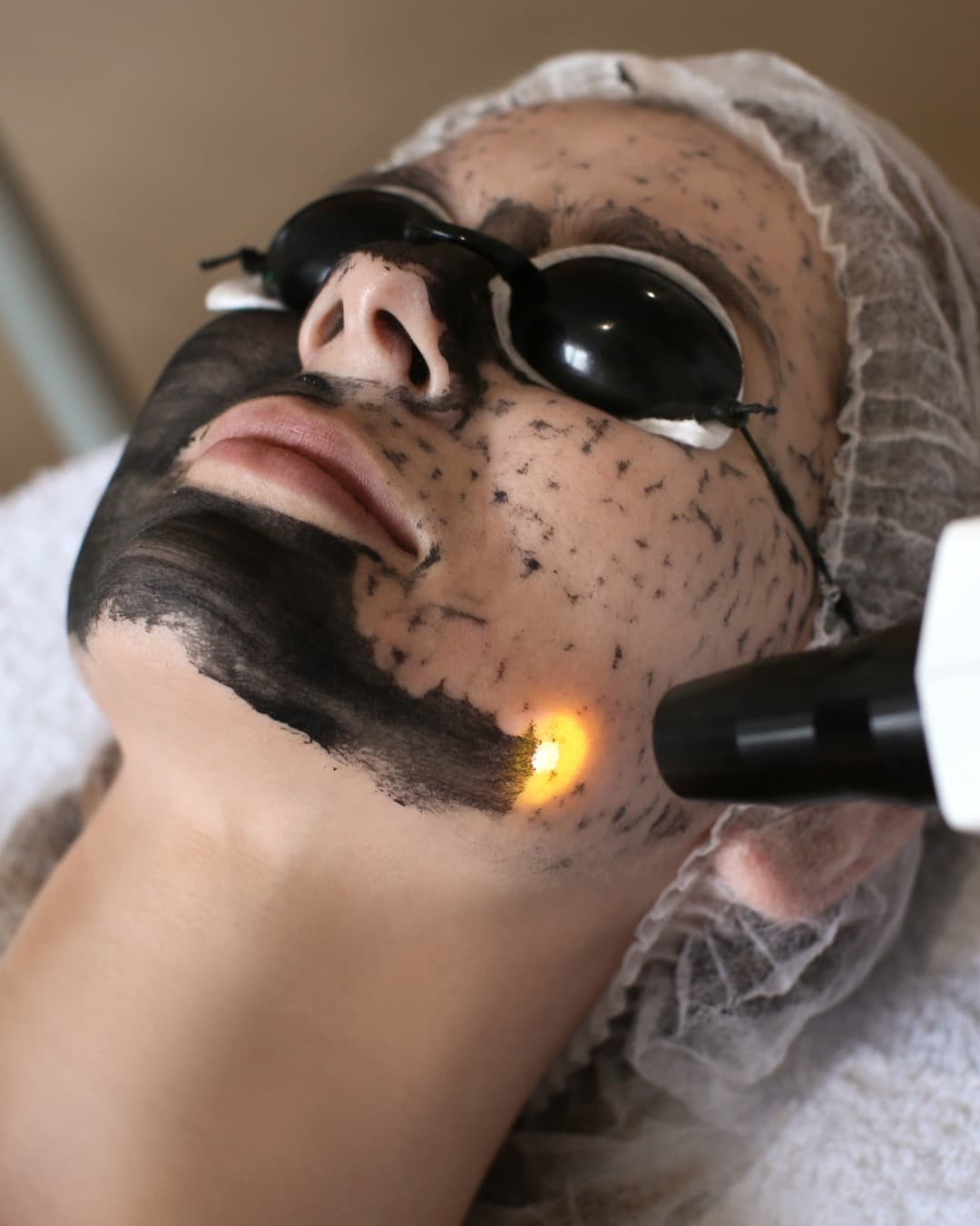 Q-Switch laser. treatment