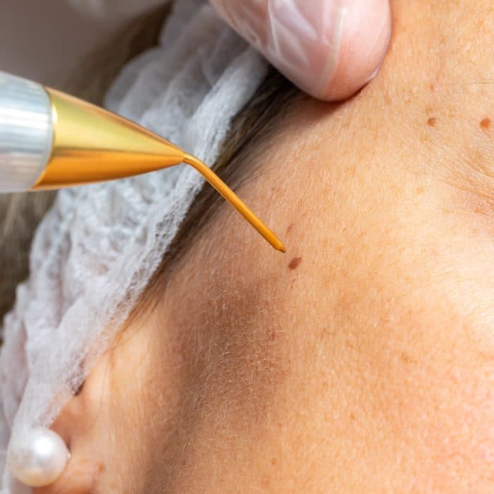Plasma fibroblast in Melbourne: tighten ageing skin without surgery
